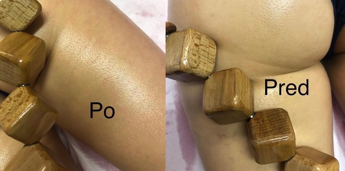 Maderoterapia Topoľčany