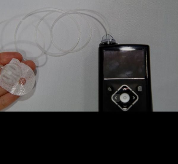 Inzulínova pumpa pre diabetikov