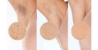 Philips Lumea 9900 - epilator pre muzov aj zeny - 11