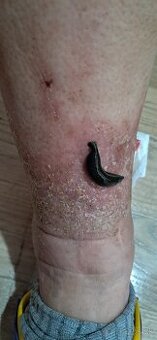 Pijavice lekárske na domáce použitie