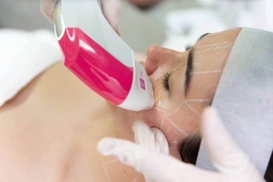 Ultraformer mpt hifu - 2