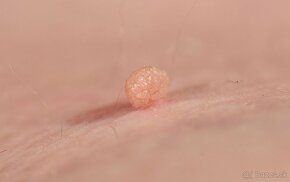 Bezbolestný odstraňovač papilómov - 2