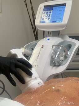 Kozmetický prístroj Liposonix-liposukcia - 2