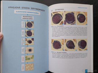 Myelodysplastický syndrom - Diagnostický atlas - 3