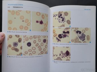 Myelodysplastický syndrom - Diagnostický atlas - 4