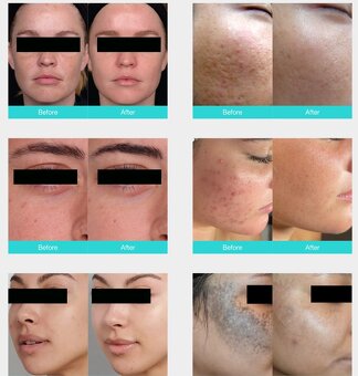 Thulium Laser F2 FX - L01 - 5